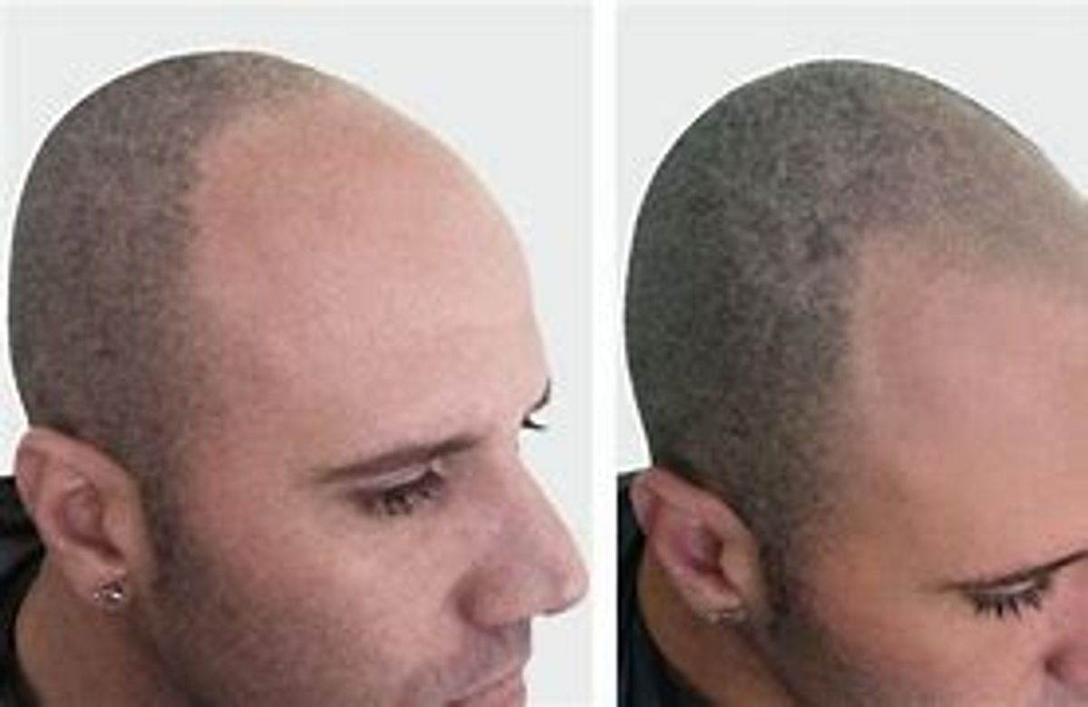 Scalp Micropigmentation UK