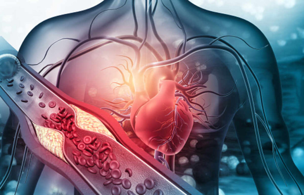atherosclerosis