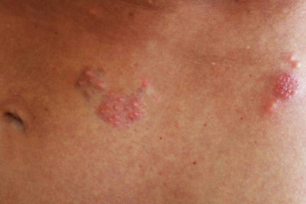 shingles rash
