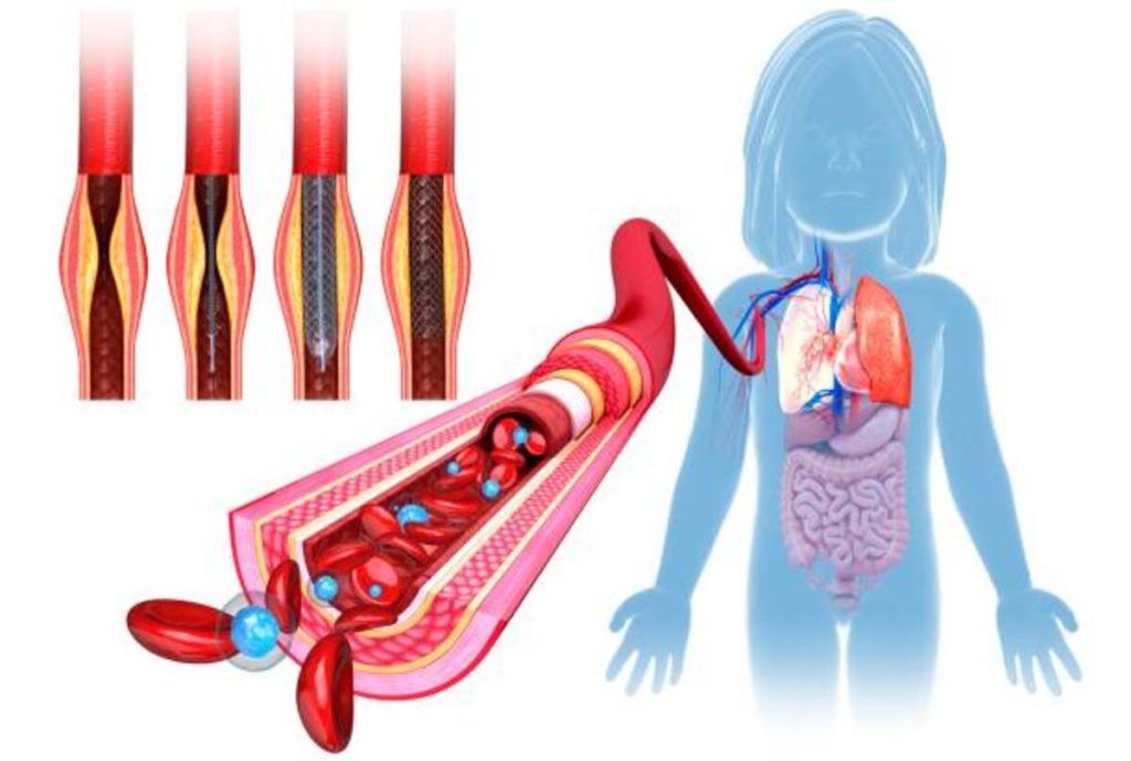 stenosis