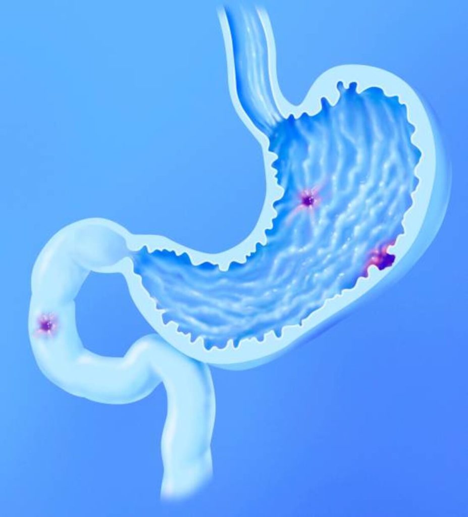 stomach ulcer symptoms