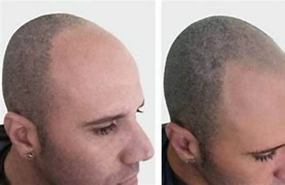 Just what Should You Expect During Your Remaining hair Micropigmentation Session?