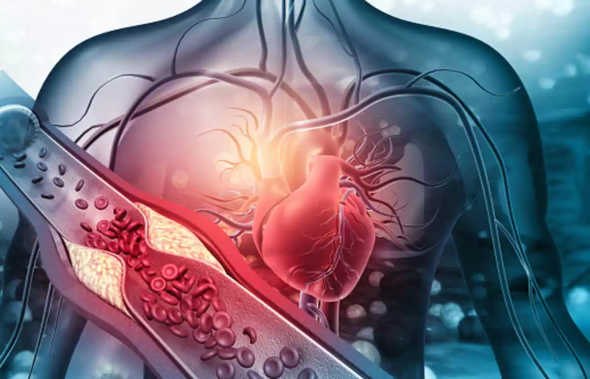 What is Atherosclerosis?
